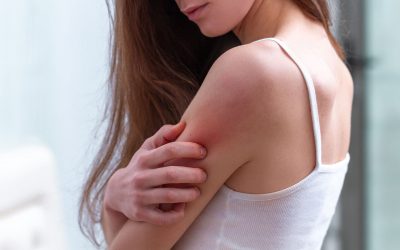 Krätze – Behandlung der Krankheit